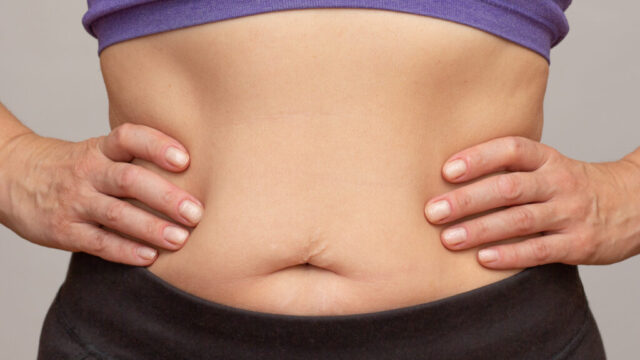 Woman’s midsection showing abdominal fat, commonly associated with insulin resistance and metabolic health issues.