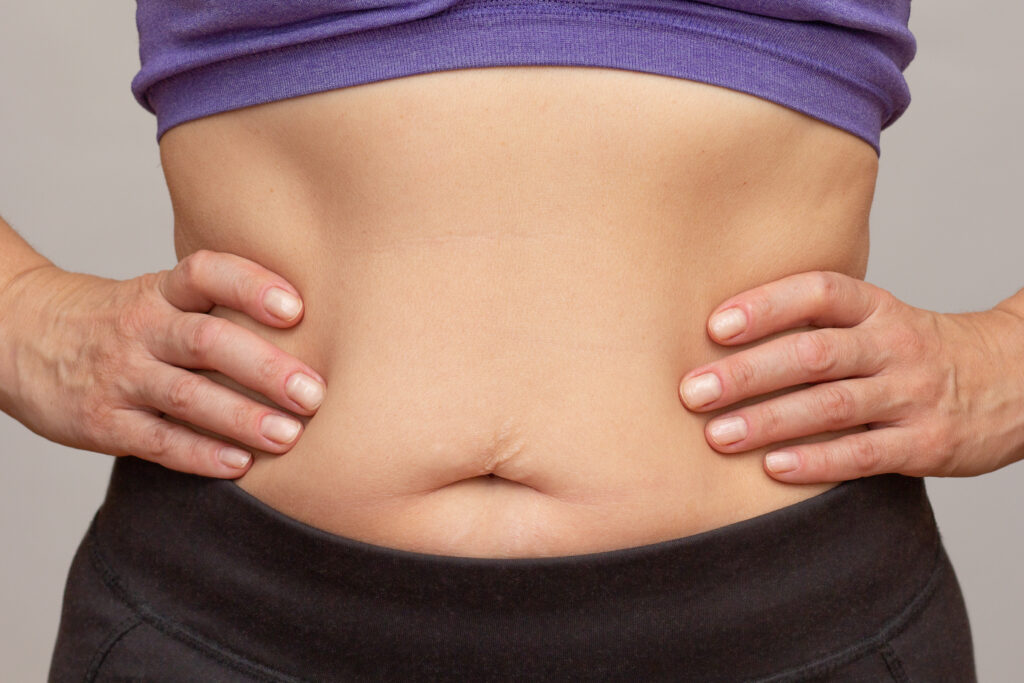 Woman’s midsection showing abdominal fat, commonly associated with insulin resistance and metabolic health issues.